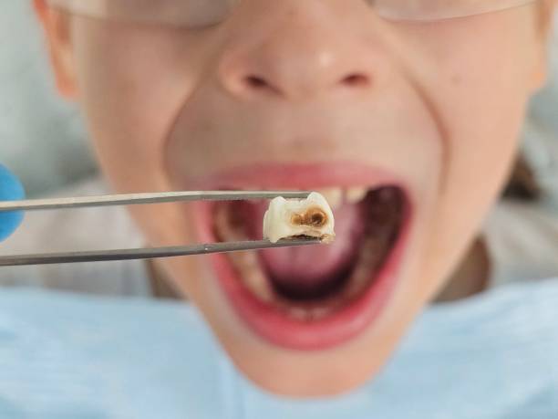 Best Emergency Dentist for Knocked-Out Tooth in Laurens, IA